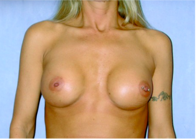 Breast Implant Correction Before