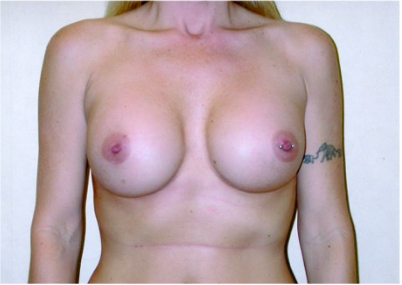 Breast Implant Correction After