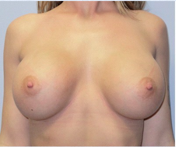 Breast Implant Correction Before