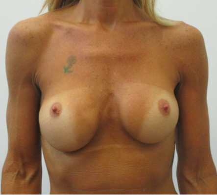 Breast Implant Correction Before