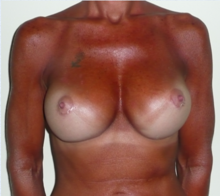 Breast Implant Correction After