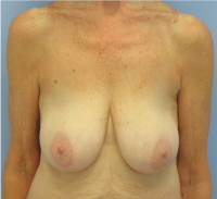 Breast Implants with Lift Before