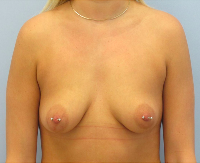 Breast Implants with Lift Before