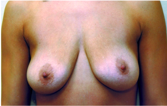 Breast Implants with Lift Before