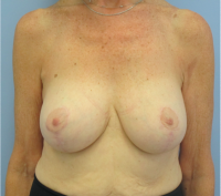 Breast Implants with Lift After