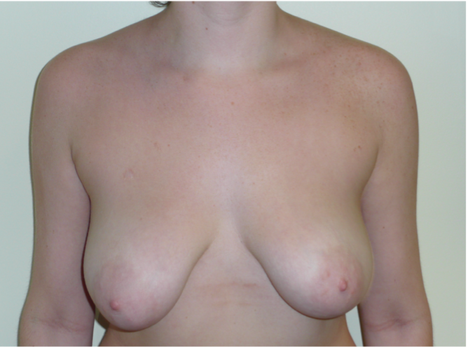 Breast Lift Before