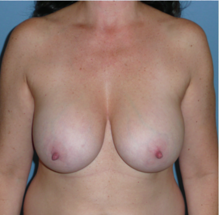 Breast Explant Before