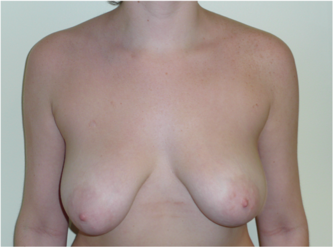 Breast Lift Before