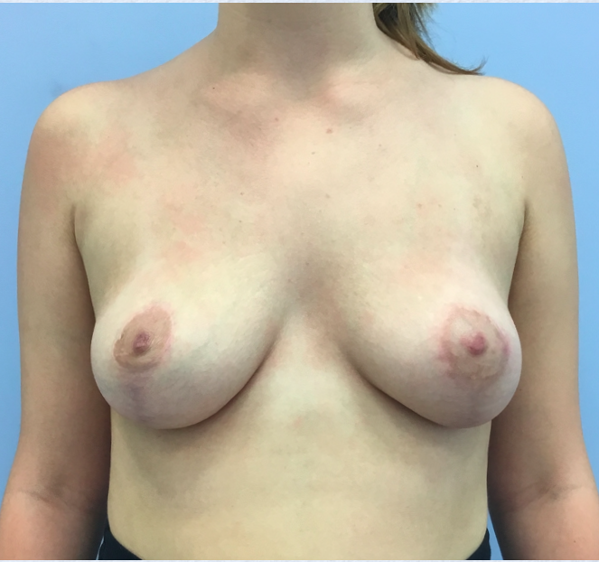 Breast Lift After