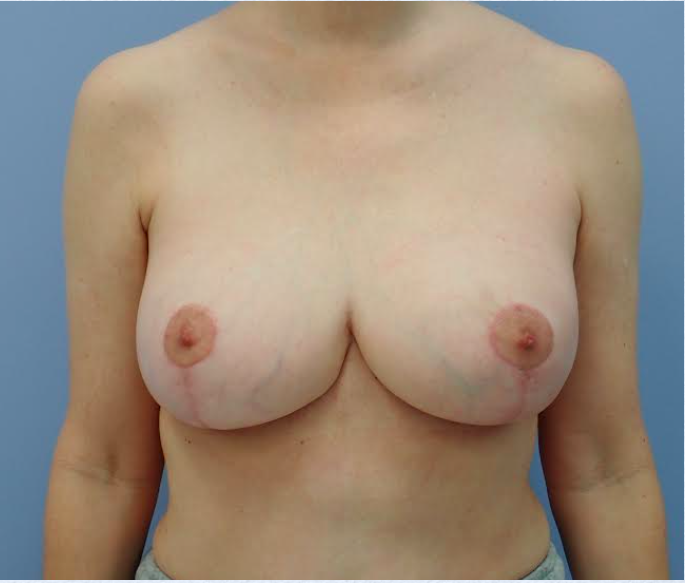 Breast Lift After