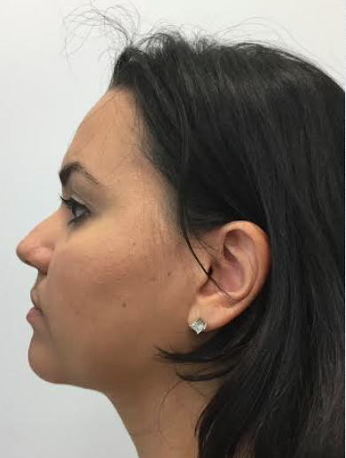 Neck Liposuction, Platysmaplasty, Chin Implant After