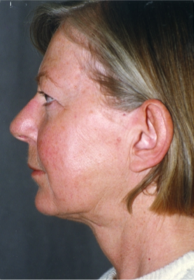 Neck Liposuction, Platysmaplasty, Chin Implant After