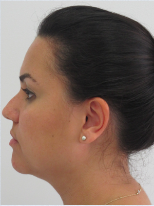 Neck Liposuction, Platysmaplasty, Chin Implant Before