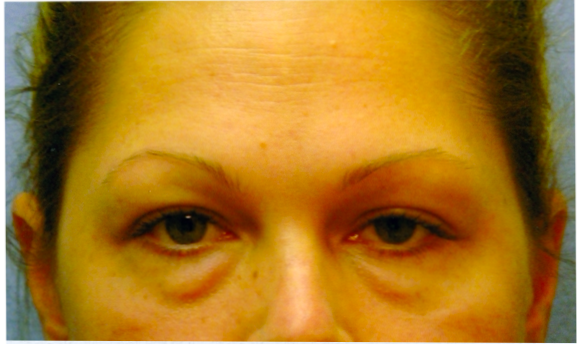 Eyelid Surgery Before