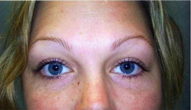 Eyelid Surgery After