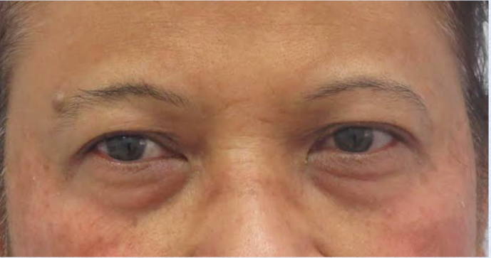 Eyelid Surgery Before