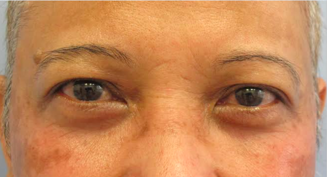 Eyelid Surgery After