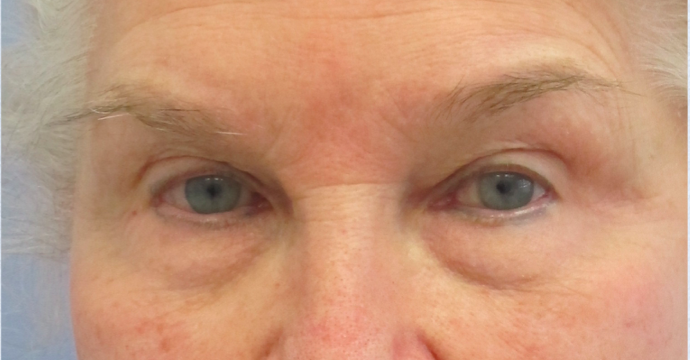 Eyelid Surgery Before