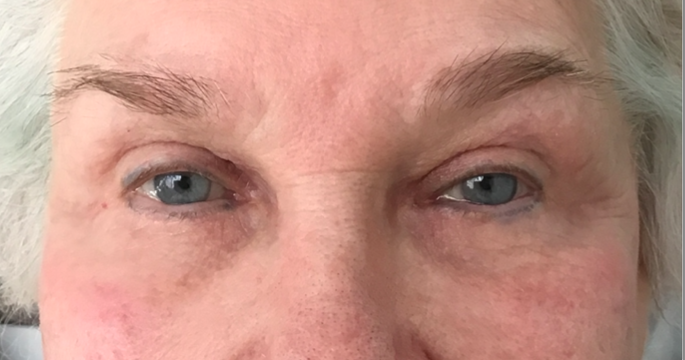 Eyelid Surgery After