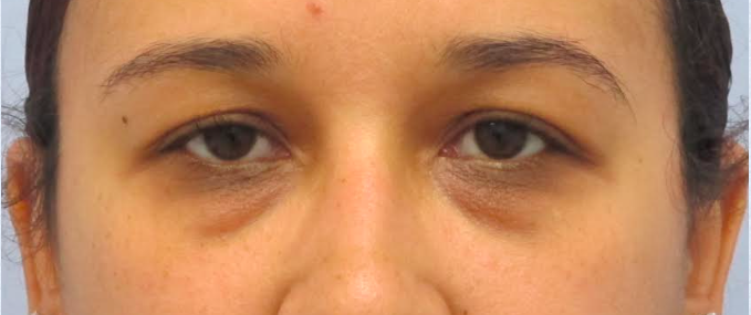 Eyelid Surgery Before