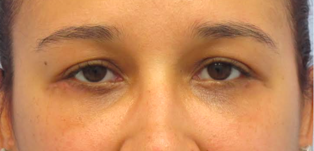 Eyelid Surgery After