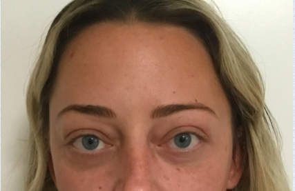 Eyelid Surgery After