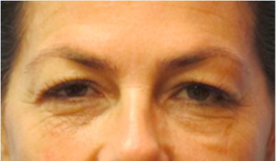 Eyelid Surgery Before