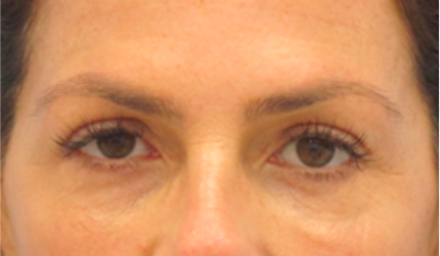 Eyelid Surgery After