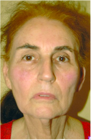 Facelift Before