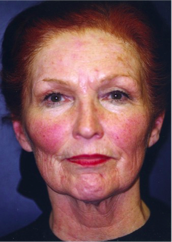 Facelift Before