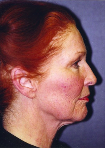 Facelift Before