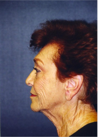 Facelift Before