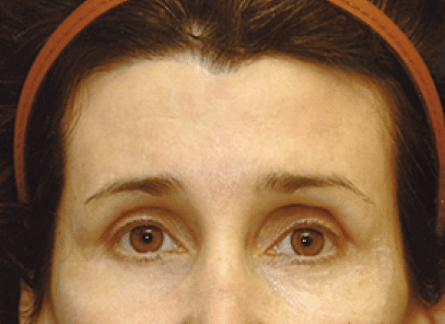 After Image: Brow Lift - front