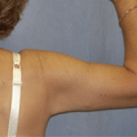 After Image: Arm Lift - back