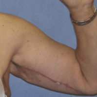 After Image: Arm Lift - front