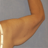 Before Image: Arm Lift - back