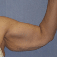 Before Image: Arm Lift - front