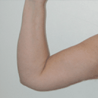 After Image: Arm Lift - front
