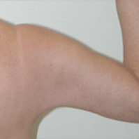 After Image: Arm Lift - back