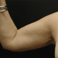 Before Image: Arm Lift - front