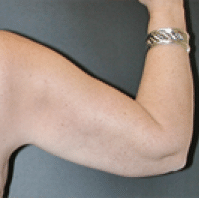 Before Image: Arm Lift - back