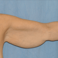 After Image: Arm Lift - front