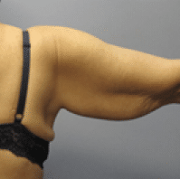 After Image: Arm Lift - 