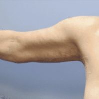 Before Image: Arm Lift - front
