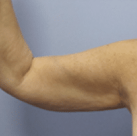 Before Image: Arm Lift - 