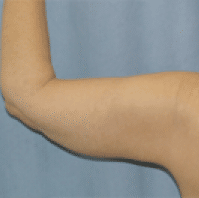 After Image: Arm Lift - back