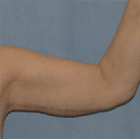 After Image: Arm Lift - front