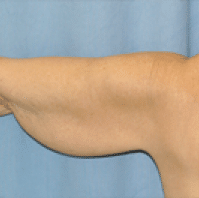 Before Image: Arm Lift - back