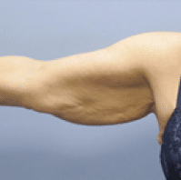 Before Image: Arm Lift - front