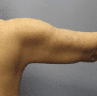 After Image: Arm Lift - front